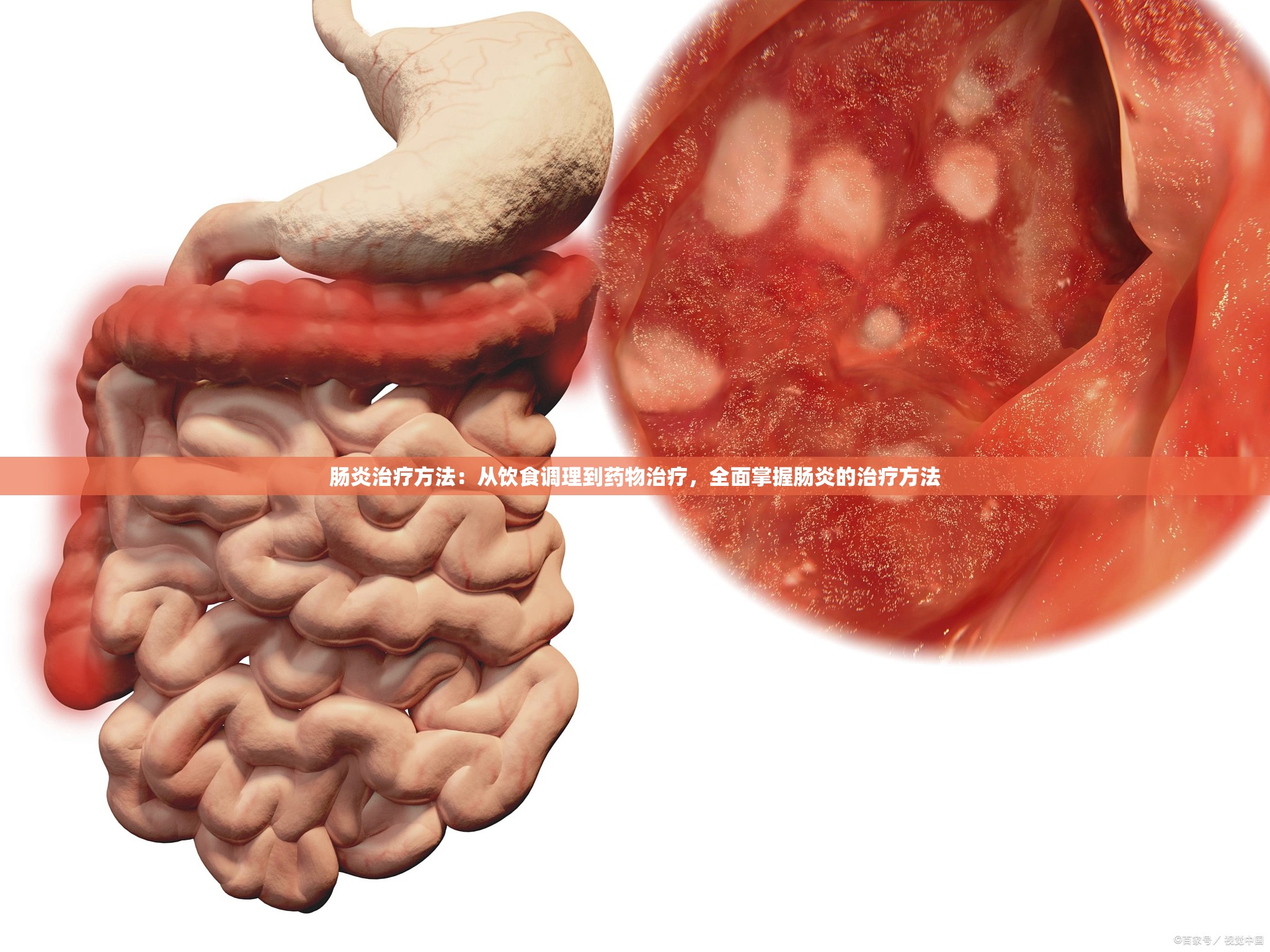 肠炎治疗方法：从饮食调理到药物治疗，全面掌握肠炎的治疗方法
