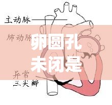 卵圆孔未闭是什么意思？卵圆孔未闭介绍_卵圆孔未闭的主要症状